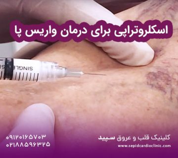 اسکلروتراپی برای درمان واریس پا