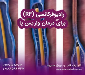 رادیوفرکانسی (RF) برای درمان واریس پا