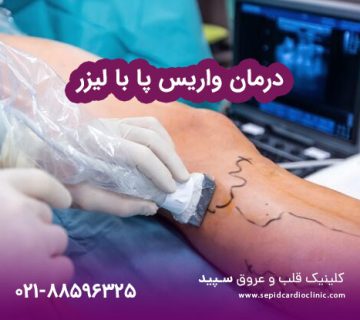 درمان واریس پا با لیزر