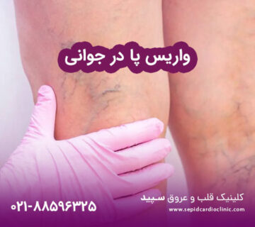 واریس پا در جوانی