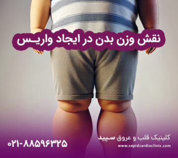نقش وزن بدن در ایجاد واریس